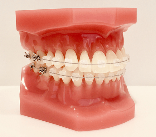 マルチブラケット矯正装置(表側の矯正