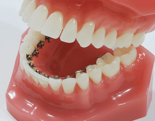 リンガルブラケット矯正装置(裏側の矯正)