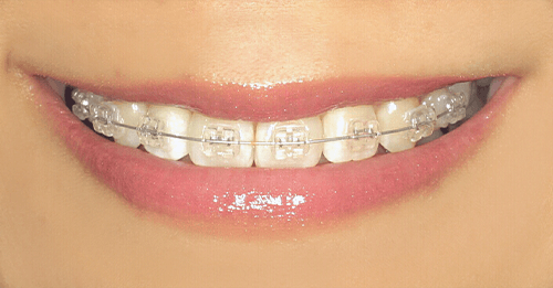 片顎矯正と部分矯正