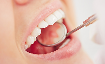 矯正治療中の虫歯プログラム